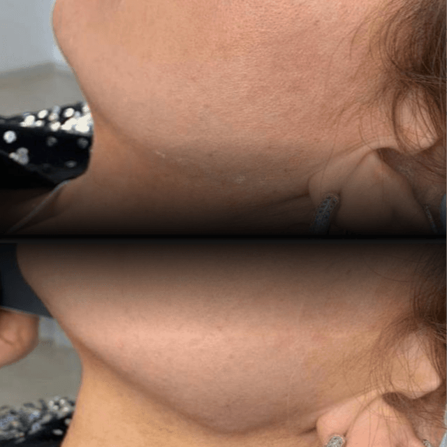 Facial Balancing- Bronze at Absolut Health and Wellness in Atlanta, GA