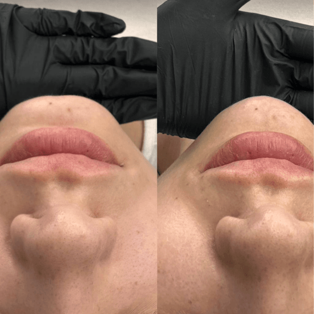 Chin and Jawline at Absolut Health and Wellness in Atlanta, GA
