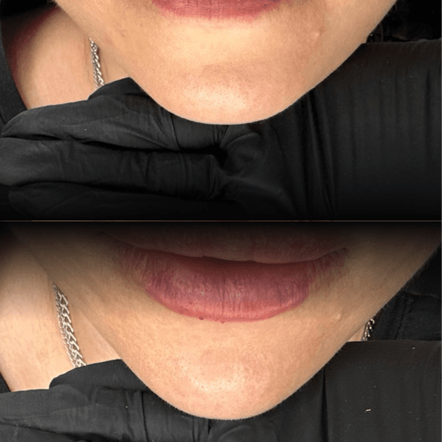 Facial Balancing- Gold at Absolut Health and Wellness in Atlanta, GA