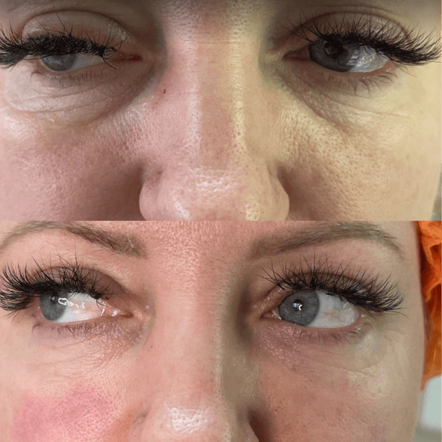 Facial Balancing- Platinum at Absolut Health and Wellness in Atlanta, GA